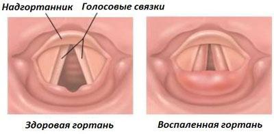 Голосовые связки при ларингите