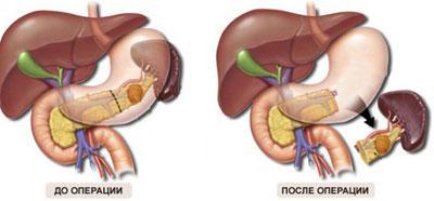 Удаление селезенки
