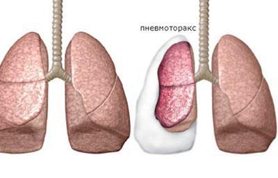 Пневмоторакс легкого