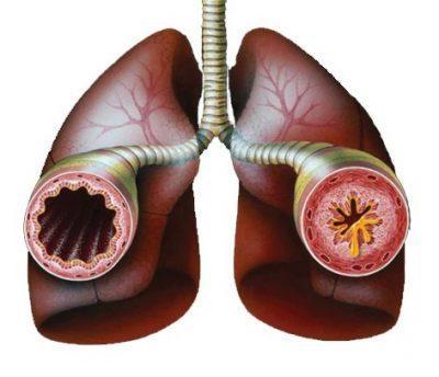 Бронхи сужаются;