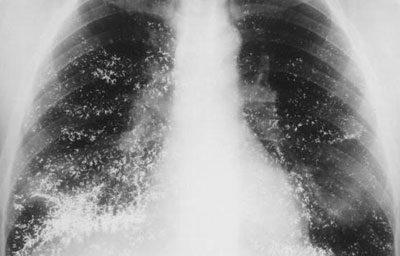Нозокомиальная пневмония на рентгене