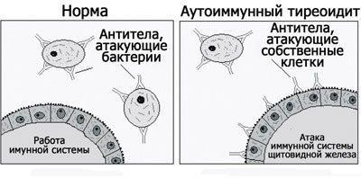 Суть тиреоидита
