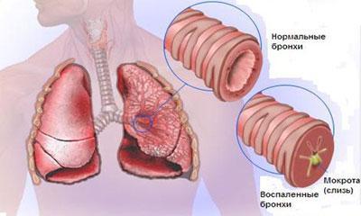 Проявление бронхита