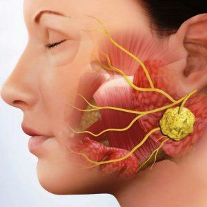 Заглоточный абсцесс