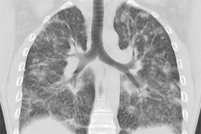 Метастазы в легких