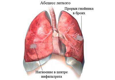 Абсцесс легкого