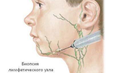 Пункция лимфаузла