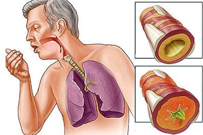 Сужение просвета бронхов