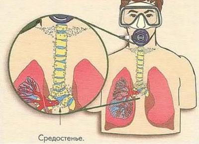 Подкожная эмфизема