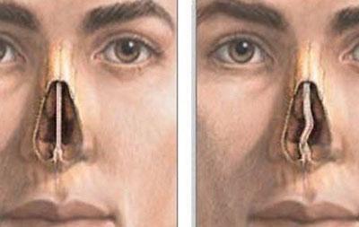 Искривление носовой перегородки