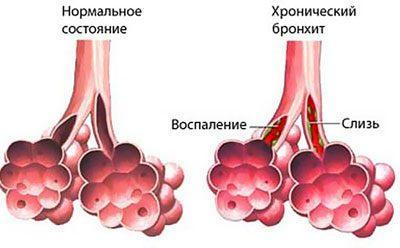 Проявление бронхита