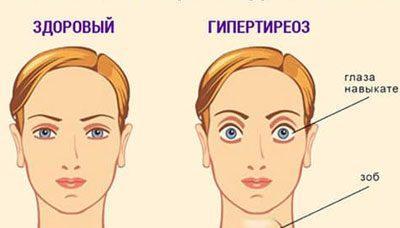 Симптомы гипертиреоза