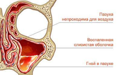 Гной в гайморовой пазухе