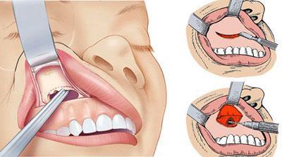 Киста пазухи верхней челюсти: причины, симптомы