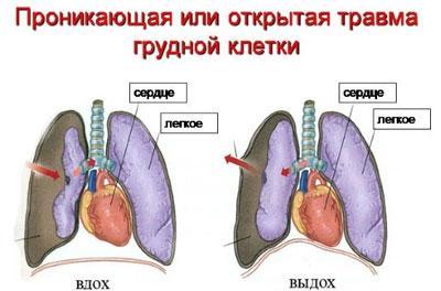 Травма грудной клетки