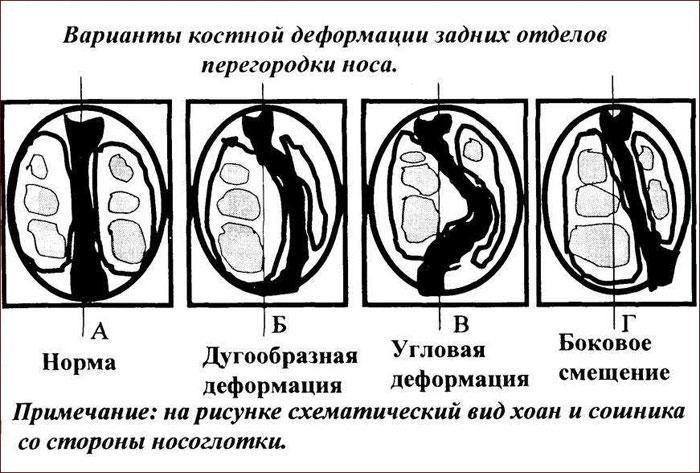 Типы деформации носовой перегородки.
