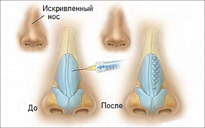 Контурная пластика носа.