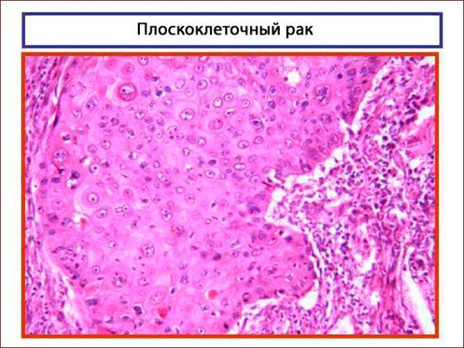 Плоскоклеточный рак