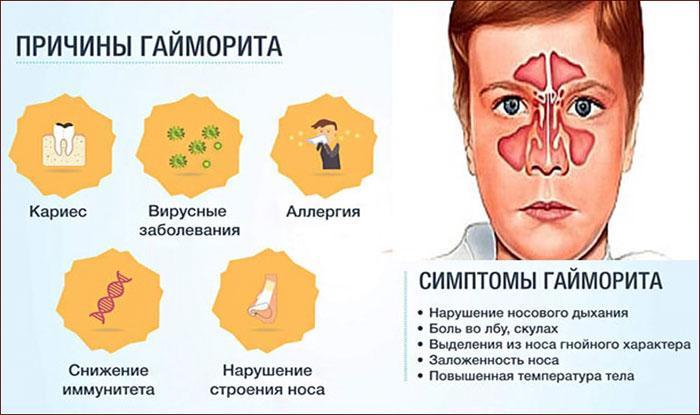 Причины и симптомы гайморита