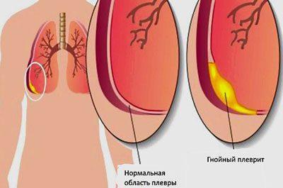 Проявление плеврита