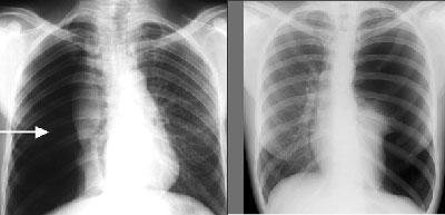 Пневмоторакс на рентгене