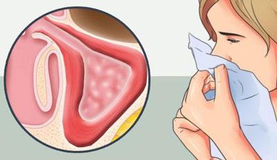 Воспаление слизистой носа
