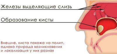 Образование кисты