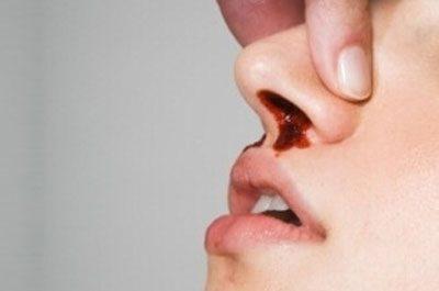 Кровотечение из носа