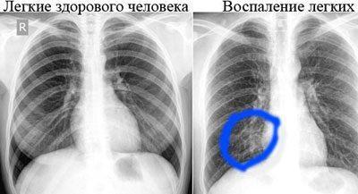 Воспаление легких на снимке