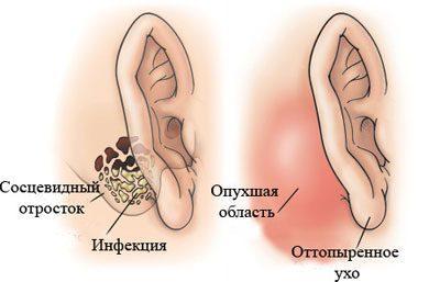 Проявление мастоидита