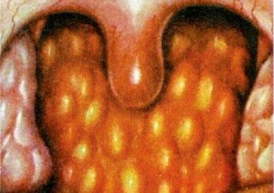 Острый герпетический фарингит