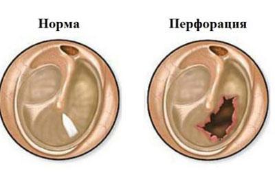 Повреждение барабанной перепонки