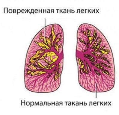 Пневмоторакс у младенца