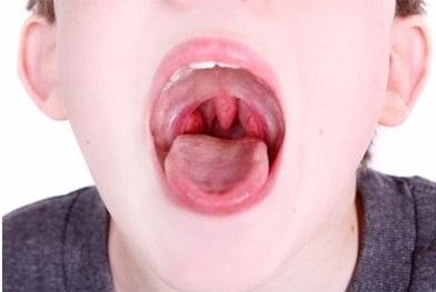 Гланды у ребенка