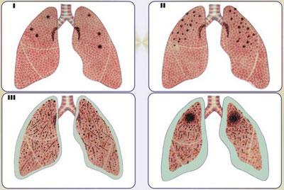 Стадии силикоза