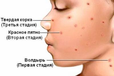 Развитие ветрянки