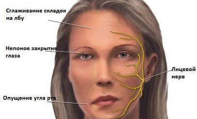 Парез лицевого нерва