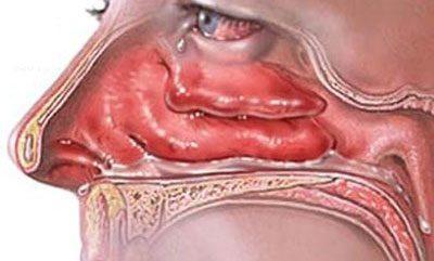 Воспаление слизистой носа