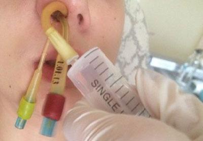 Установка ямик катетера