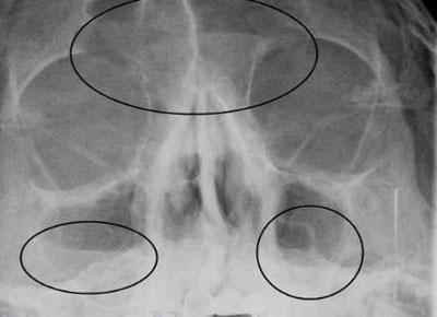 Гайморит на рентгене